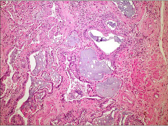 Fibrosis pulmonar idioptica - <div style=