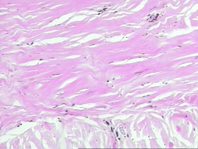 Figura 3 - Detalle de la prominente proliferacin colagnica paucicelular.