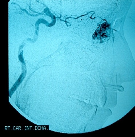angiografa - Angiografa que muestra lesin de aspecto vascular dependiente de la arteria oftlmica