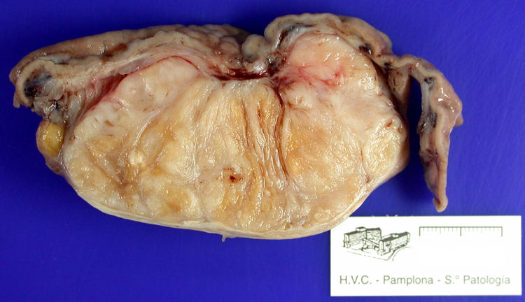 Figura 1. Tumor gstrico de 9 cm dimetro mayor.