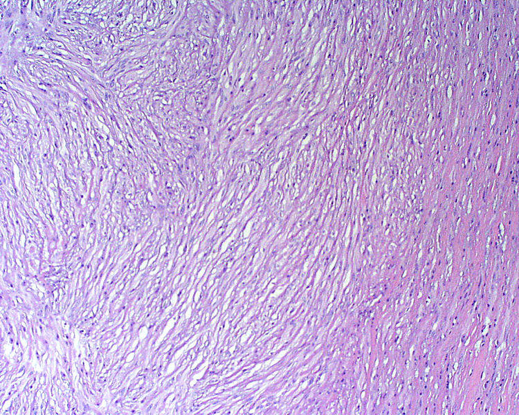 Figura 2. Clulas fusiformes onduladas (HE)