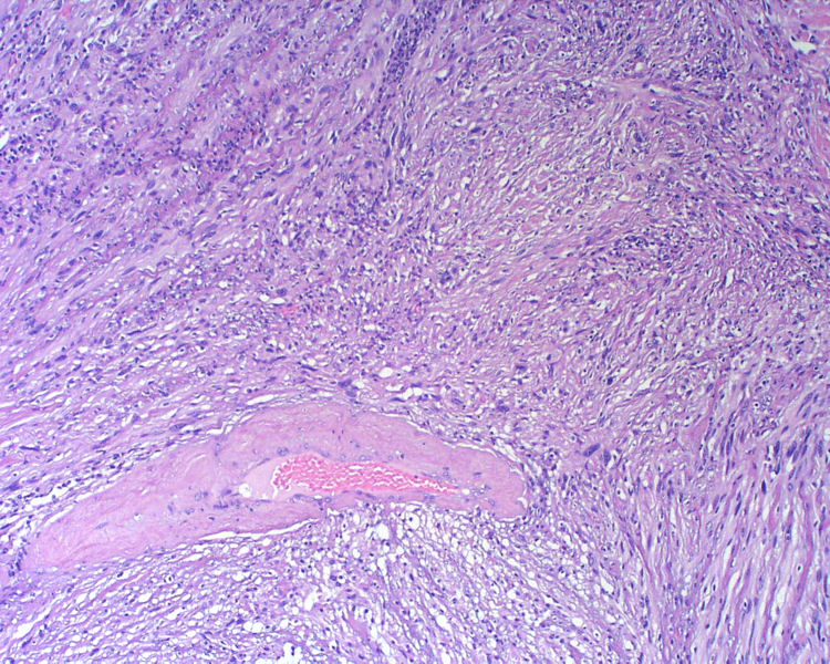 Figura 3. Area con atipia nuclear e hialinizacin de vasos (HE)