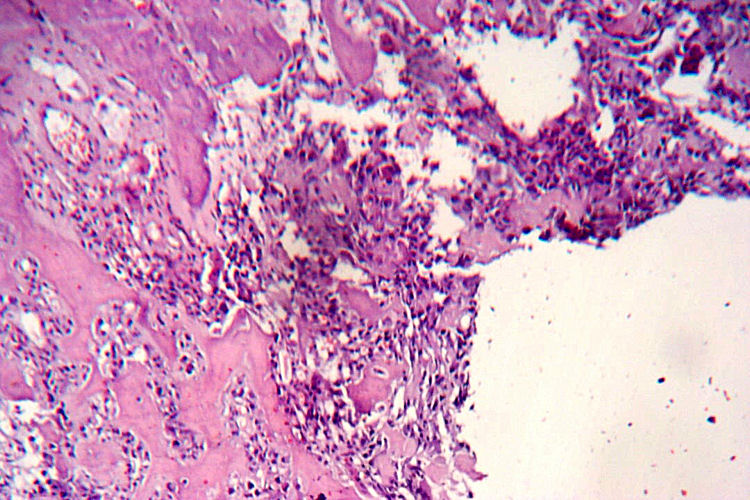 Figura 7: HISTOLOGIA. Infiltracin de las trabculas seas nativas. (10x)