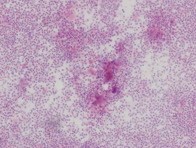 Figura 1 - Frotis con marcada celularidad. Abundantes neutrfilos polimorfonucleares. Fondo con material granular eosinfilo.