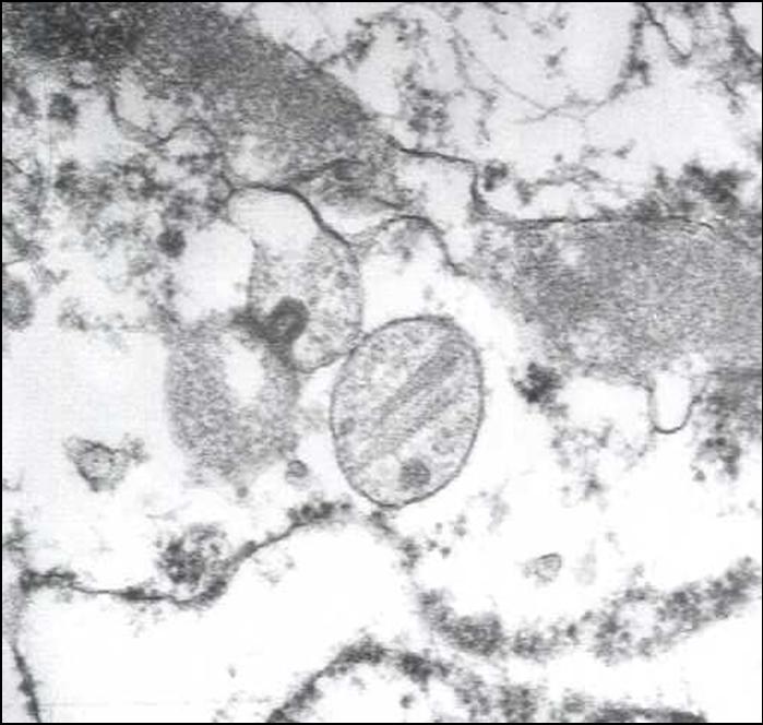 FIGURA 8 - El estudio ultraestructural demuestra la presencia de ocasionales melanosomas en el citoplasma de las celulas tumorales