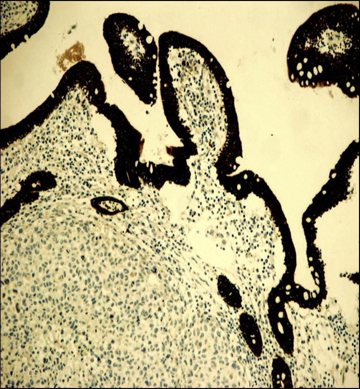 FIGURA 7F - Las clulas neoplsicas fueron negativas para panqueratinas(AE1/AE2) y queratina K903.