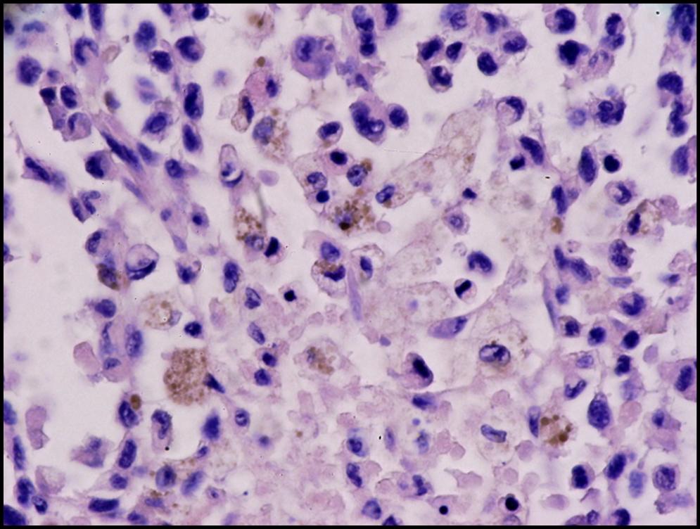 FIGURA 5 - Tincin H-E.(40x). Las clulas tumorales tienen ncleos irregulares, hipercromticos y  bizarros, con abundantes mitosis. Los citoplasmas son eosinfilos, y en algunos de ellos se observa pigmento