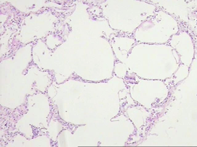 Figura 1 - Area de pulmn con dilatacin alveolar y escaso componente intersticial. Esta sobredilatacin de los espacios alveolares determina un cambio en panal radiolgico y macroscpico.