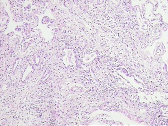 Figura 4 - Fibrosis intersticial que destruye la arquitectura pulmonar.