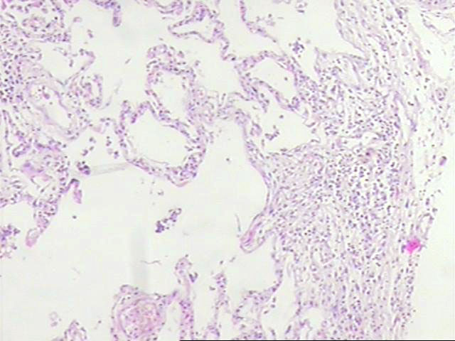 Figura 2 - En este sector la inflamacin y fibrosis septal son ms importantes y rodean alvolos distorsionados
