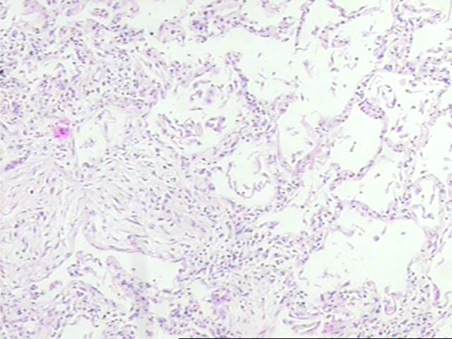 Figura 3 - Sector de fibrosis colagnica desorganizada adyacente a un sector con los alvolos relativamente preservados. No se ven focos de fibroblastos ni inmadurez de la fibroplasia.