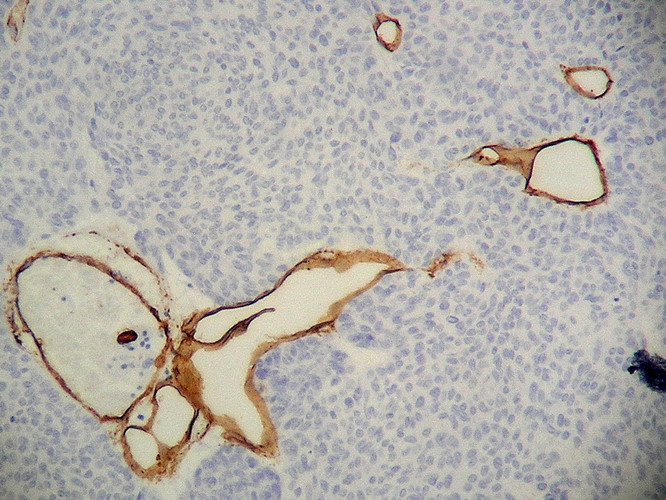 Fig. 13 - CD34 positivo en el endotelio vascular.