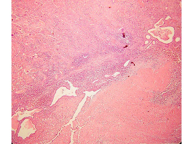 T.T.I.Placentaria. Est. Microscpico - B06-260. 50X Miometrio con infiltardo inflamatorio crnico rodeando a clulas de trofoblasto intermedio y foco de adenomiosis.