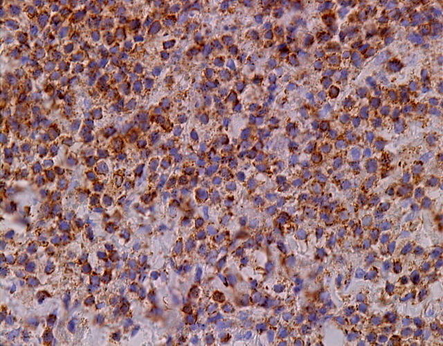 Fig. 4 - Las clulas neoplsicas expresan CD epsilon.