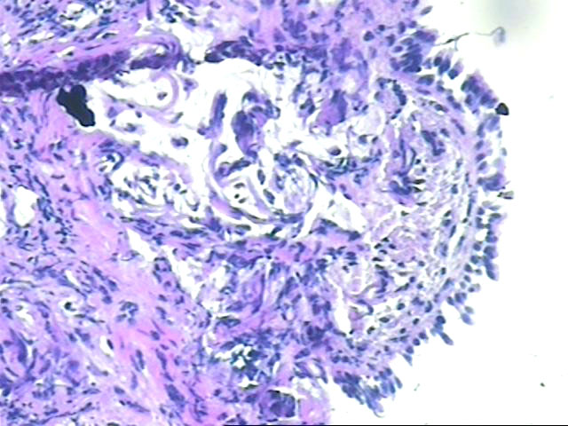 Figura 7 - En sectores las clulas carcinomatosas estn muy cercanas al epitelio bronquial. El observador distrado puede confundir estos acmulos malignos con granulomas peribronquiales y diagnosticar una neumonitis alrgica.