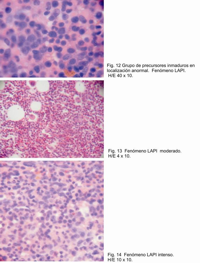 Fig 12, 13, 14. - Presencia del fenmeno LAPI.