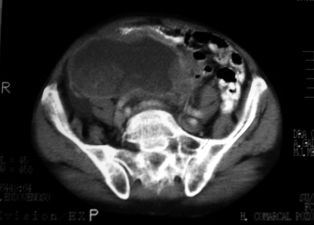 Figura 1 - TAC con contraste en el que se observa una gran masa plvica, con captacin heterognea, sobre todo en sus bordes, que parece infiltrar el tubo digestivo.