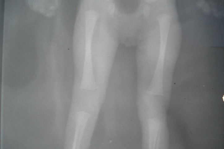 Radiografa de MI. Agenesia Patelar - <div style=