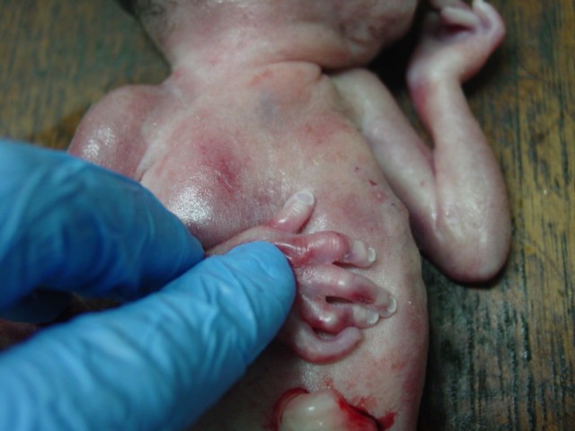 Akinesia fetal, Alteraciones de las manos. - <div style=