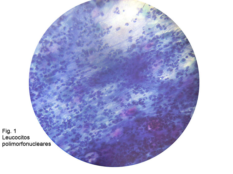Figura 1. Leucocitos polimorfonucleares