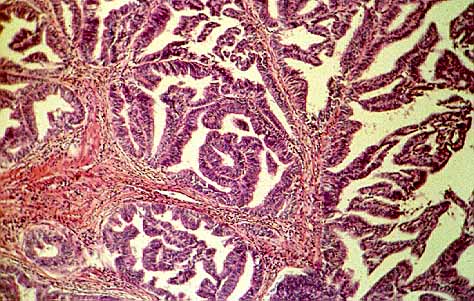 Tumoracin endometrial