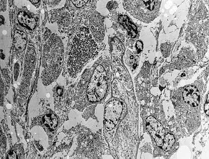 Clulas epiteliales poco diferenciadas x 1200