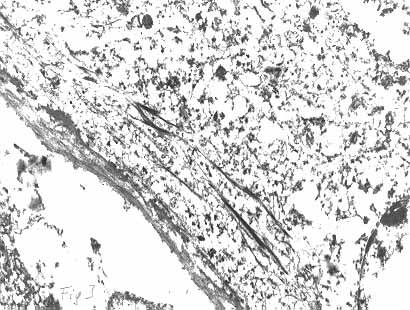 Clulas tumorales con escasas tonofibrillas x 6000