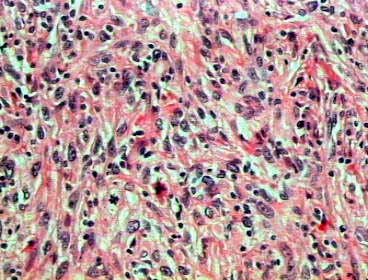 reas semejantes al fibrohistiocitoma maligno x 200