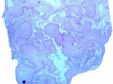 Areas pseudoepiteliomatosas x 40