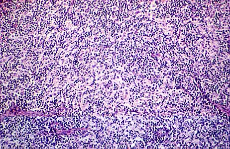 Histiocitos en reas paracorticales