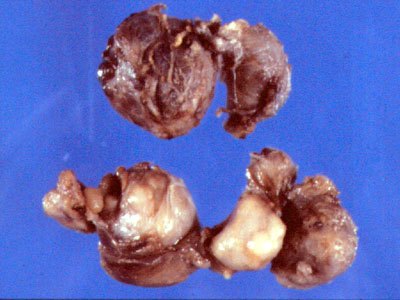 Tiroides multinodular