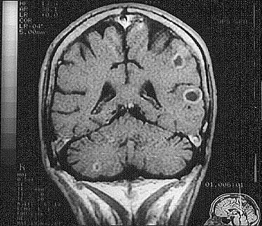 RNM cerebro y cerebelo