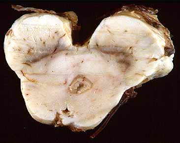 Macroscpica mesencfalo