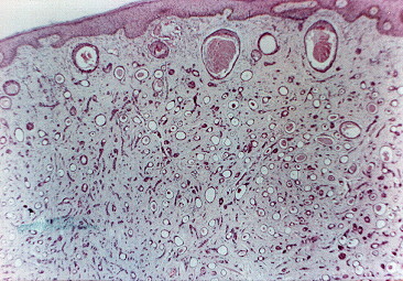 Fig. 1.- Carcinoma esclerosante de conductos sudorparos