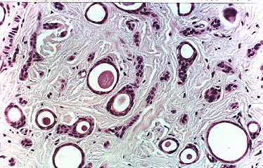 Fig. 3.- Carcinoma esclerosante de conductos sudorparos