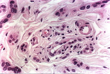 Fig. 4.- Carcinoma esclerosante de conductos sudorparos