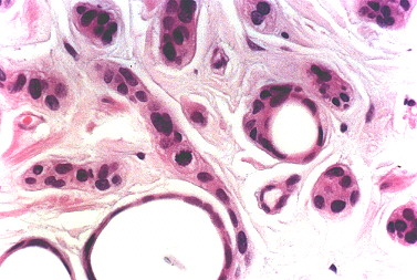 Fig. 5.- Carcinoma esclerosante de conductos sudorparos