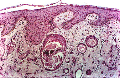 Fig. 2.- Carcinoma esclerosante de conductos sudorparos