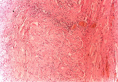 Fig. 1.- Biopsia lengua.