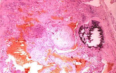 Fig. 1.- Hemangioendotelioma de clulas fusiformes solitario