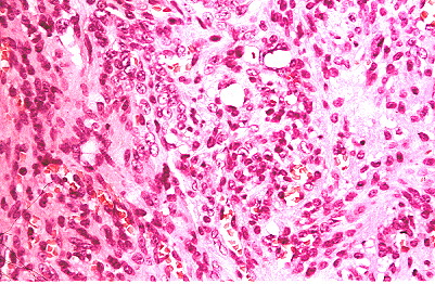 Fig. 2.- Hemangioendotelioma de clulas fusiformes solitario