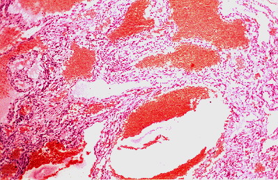 Fig. 3.- Hemangioendotelioma de clulas fusiformes solitario