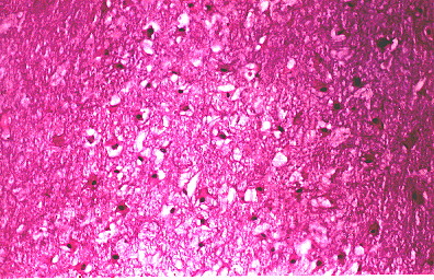 Fig. 4.- Hemangioendotelioma de clulas fusiformes solitario