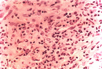 Fig. 2.- Pseudotumor inflamatorio 