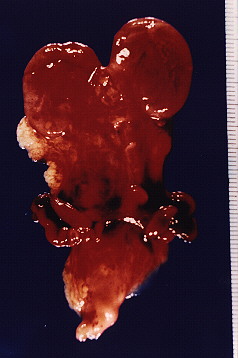 Fig.4 .- Paquete retroperitoneal. 