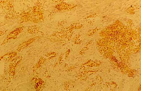 Fig. 19. RECEPTORES DE PROGESTERONA EN CARCINOMA DE MAMA