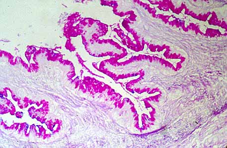 Fig. 29. CISTOADENOMA MUCINOSO DIPLOIDE