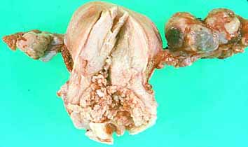 Fig. 36. ADENOCARCINOMA DE UTERO