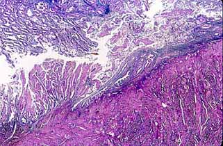 Fig. 37. ADENOCARCINOMA DE ENDOMETRIO