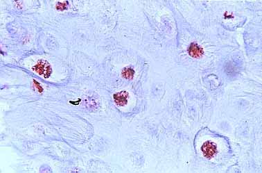 Fig. 42. HIBRIDACIN IN SITU DE CIN CON PAPILOMAVIRUS POSITIVO